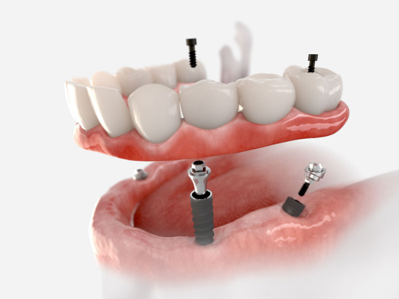 The Benefits of Fixed Dentures: Enjoy a Perfect Smile with Metropolitan ...