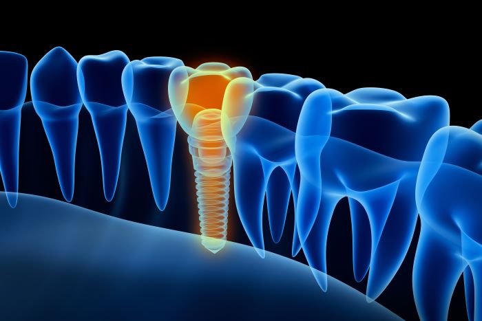 Dental Implants Specialist