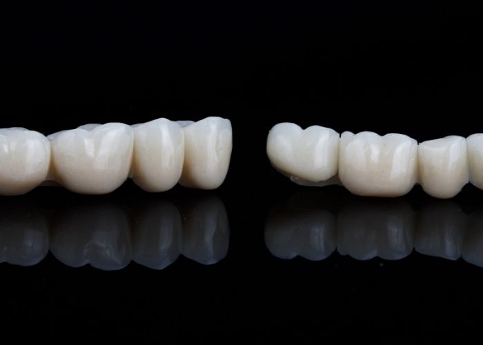 dental crown & bridges near me