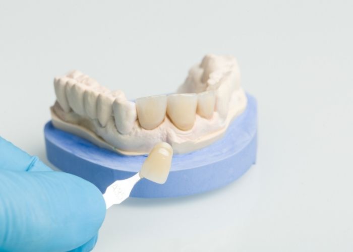dental bridges near me
